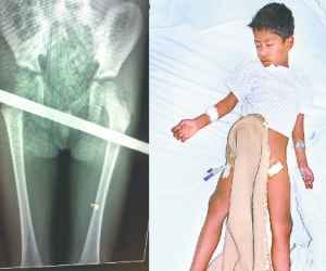 iron rod operated from 7 year old kid thighs