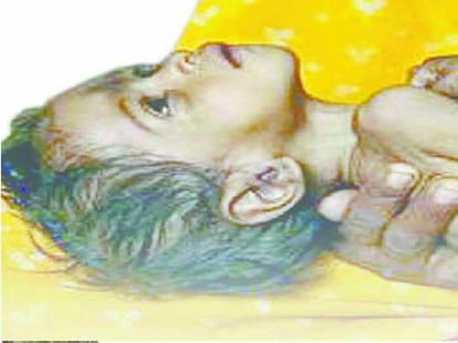 symptoms of meningitis notice like this