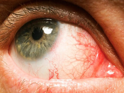 What do your EYES reveal about your health?