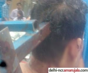 3 feet long iron rod passes mans head, aiims doctors saves his life