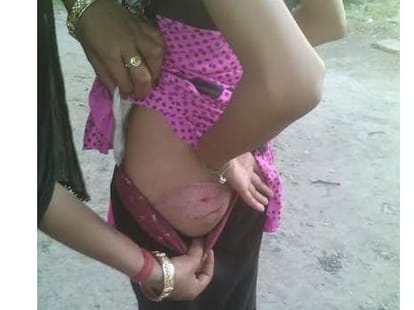 A gilrl child tortured by a couple in Lucknow.
