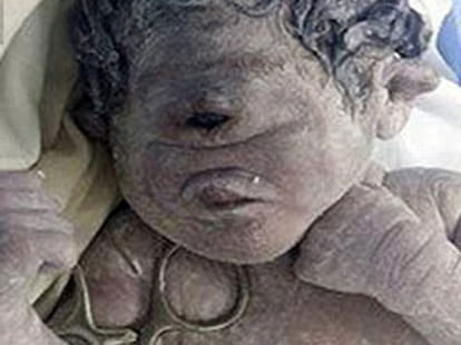 one eyed baby born in Egypt, difficult to survive
