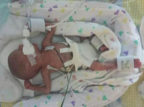 Identical Twins to Be Born Four Months Apart in Extremely Rare Delivery