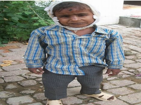 Symptoms of polio reported in Seshpal