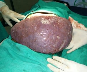 Doctors remove two KG splene from child's stomach.