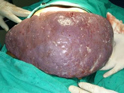 Doctors remove two KG splene from child's stomach.