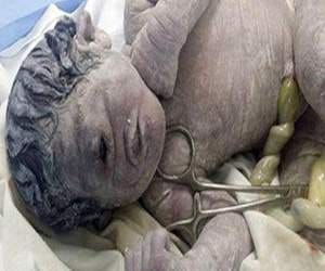 baby born with one eye in the forehead