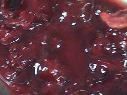 doctors do critical heart surgery in lucknow