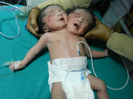 double head baby born in Bangladesh