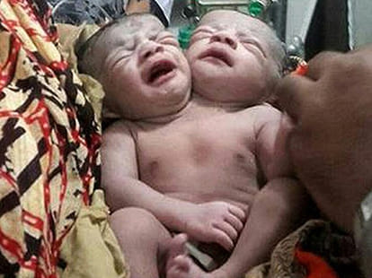 double head baby born in Bangladesh