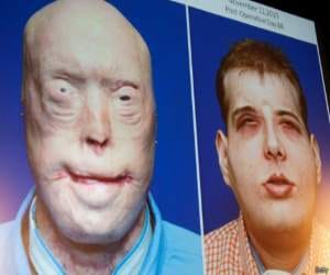 world's most extensive face transplant