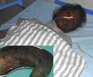 Two kilos hair come out The woman stomach.