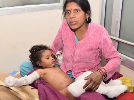fire broke out, two childs scorched.