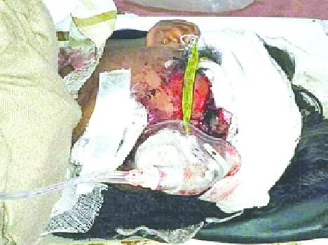Accident