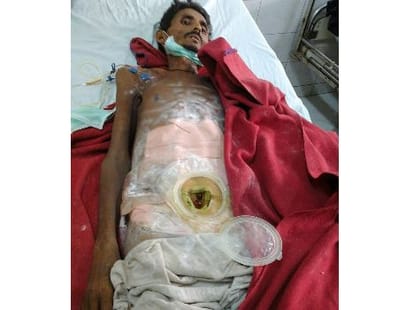 Carelessness of hospital leads a patient in a pathetic condition.