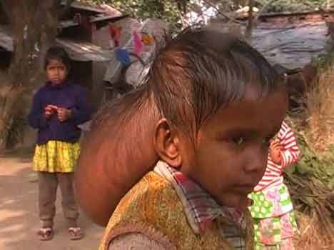 renu's tumer whose family is poor