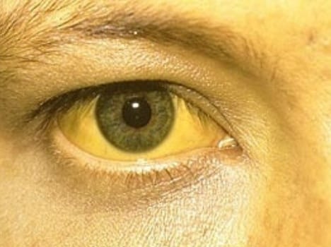 jaundice in shimla city, lady died at igmc.