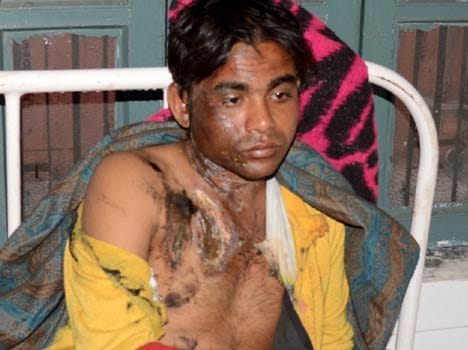 acid attack on lover