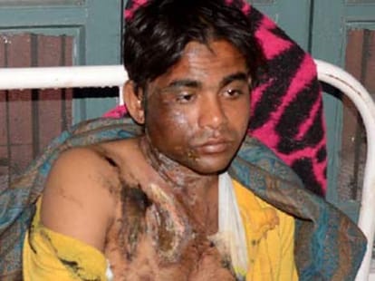 acid attack on lover