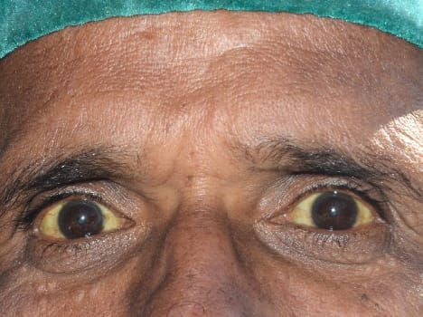 jaundice cases in shimla city.