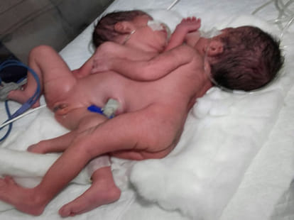 twins baby born in agra