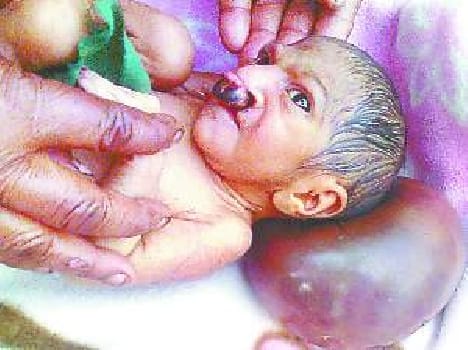 tumour of 1 kg in new born baby