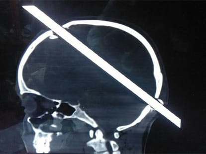 Construction worker's head is pierced by a rod