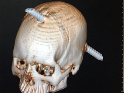 Construction worker's head is pierced by a rod