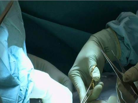 first time transplant of Uterus in america