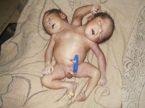 two headed child born in udhamsingh nagar.